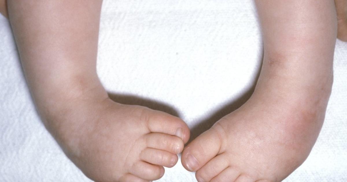 Артрогрипоз. Уникальные методики лечения